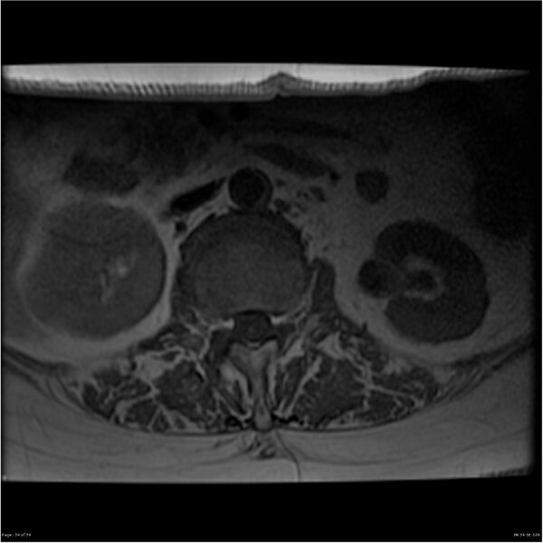 File:Bilateral psoas hematomas (Radiopaedia 24057-24280 T1 34).jpg