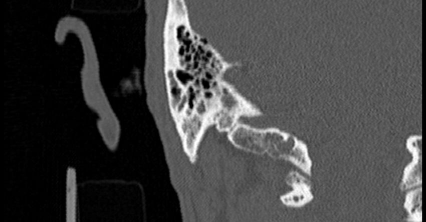 Bilateral temporal bone fractures (Radiopaedia 29482-29970 Coronal non-contrast 161).jpg