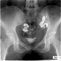 Bilateral tubal block and hydrosalpinx (Radiopaedia 23086-23116 A 5).jpg