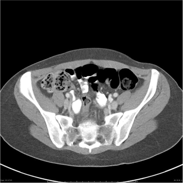 File:Bilateral ureteritis and cystitis (Radiopaedia 25340-25594 A 58).jpg