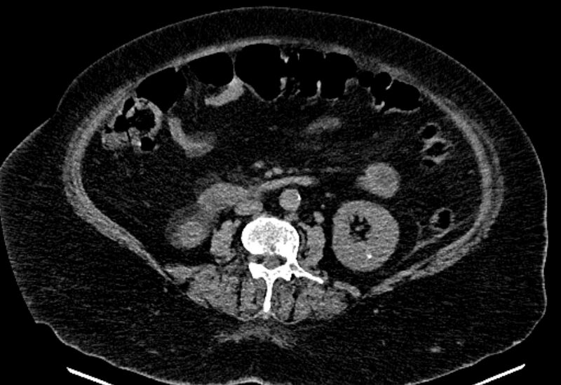 File:Biliary pancreatitis (Radiopaedia 72289-82823 Axial non-contrast 139).jpg
