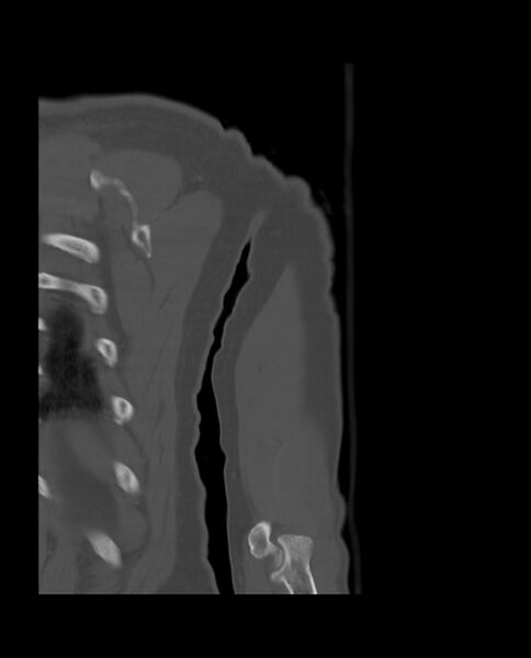 File:Bizarre parosteal osteochondromatous proliferation (Radiopaedia 84221-99501 Coronal bone window 28).jpg
