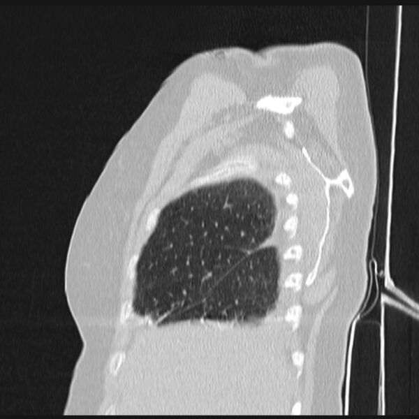 File:Boerhaave syndrome (Radiopaedia 45644-49799 Sagittal lung window 11).jpg