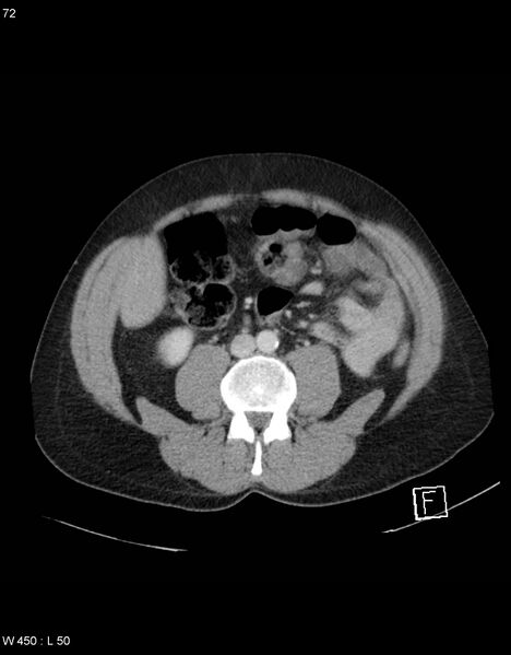 File:Boerhaave syndrome with tension pneumothorax (Radiopaedia 56794-63603 A 36).jpg