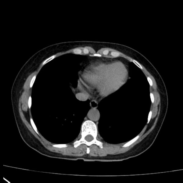 File:Bosniak renal cyst - type I (Radiopaedia 27479-27675 Axial non-contrast 6).jpg