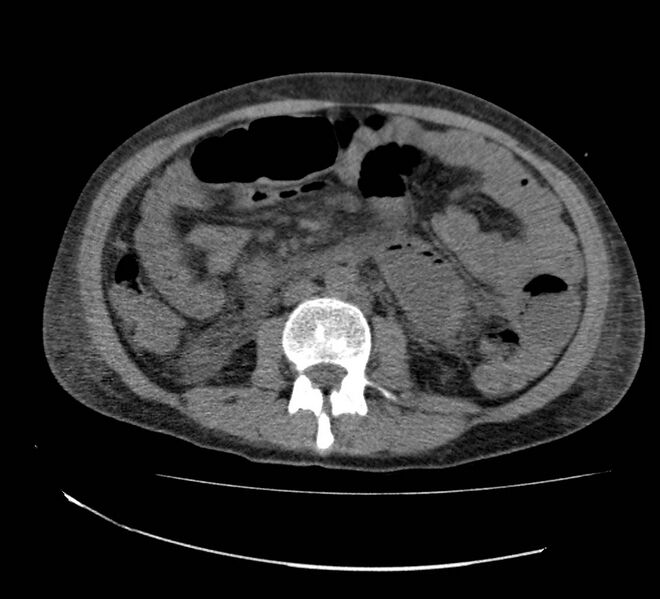 File:Bowel lymphoma complicated by bleeding after therapy (Radiopaedia 55601-62110 Axial non-contrast 41).jpg