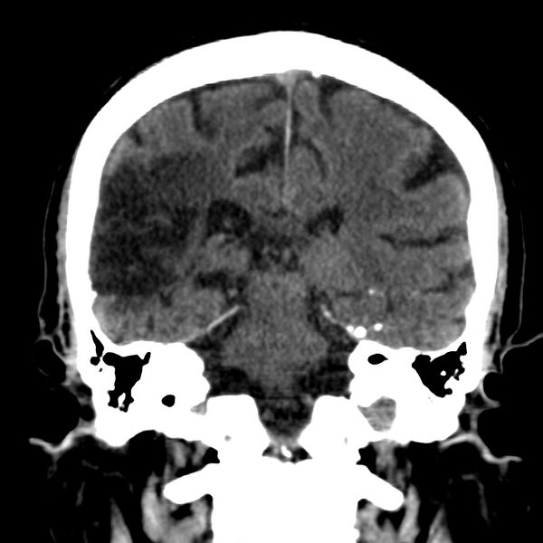 File:Brain Pantopaque remnants (Radiopaedia 78403-91048 Coronal non-contrast 43).jpg