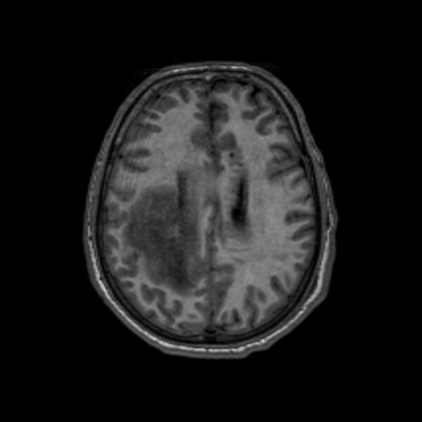 File:Brain abscess complicated by intraventricular rupture and ventriculitis (Radiopaedia 82434-96577 Axial T1 47).jpg