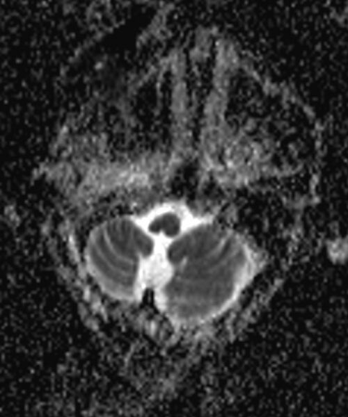 File:Brain abscess with dual rim sign (Radiopaedia 87566-103938 Axial ADC 1).jpg