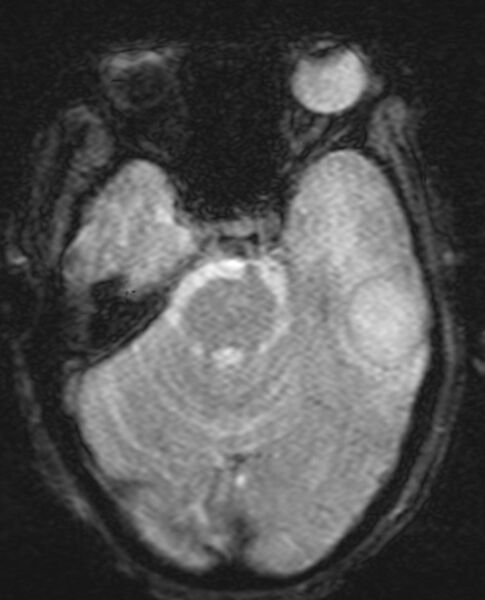 File:Brain abscess with dual rim sign (Radiopaedia 87566-103938 Axial SWI 7).jpg