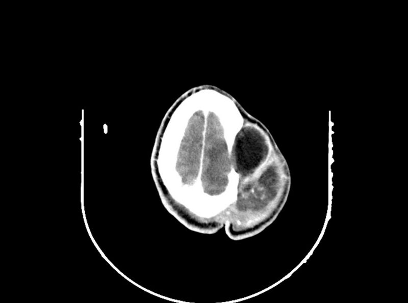 File:Brain injury by firearm projectile (Radiopaedia 82068-96088 B 188).jpg