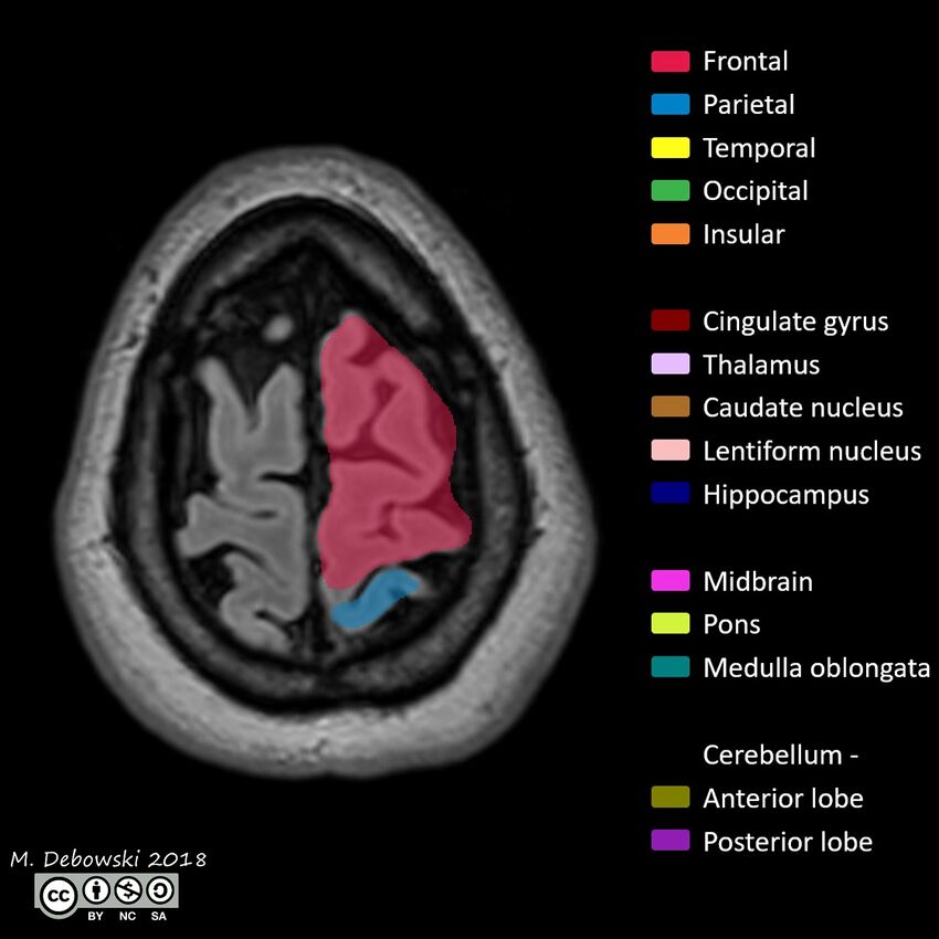 Brain lobes - annotated MRI (Radiopaedia 61691-69700 Axial 4).JPG