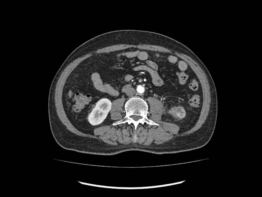 Brain metastases from renal cell carcinoma (Radiopaedia 42222-45328 A 149).jpg