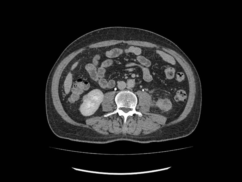 File:Brain metastases from renal cell carcinoma (Radiopaedia 42222-45328 Axial C+ delayed 152).jpg