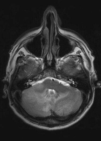 File:Brain metastases from squamocellular lung cancer (Radiopaedia 56515-63222 Axial T2 7).jpg