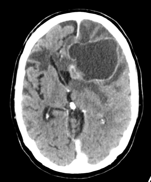 File:Brain metastasis (lung cancer) (Radiopaedia 48289-53177 Axial C+ 15).png