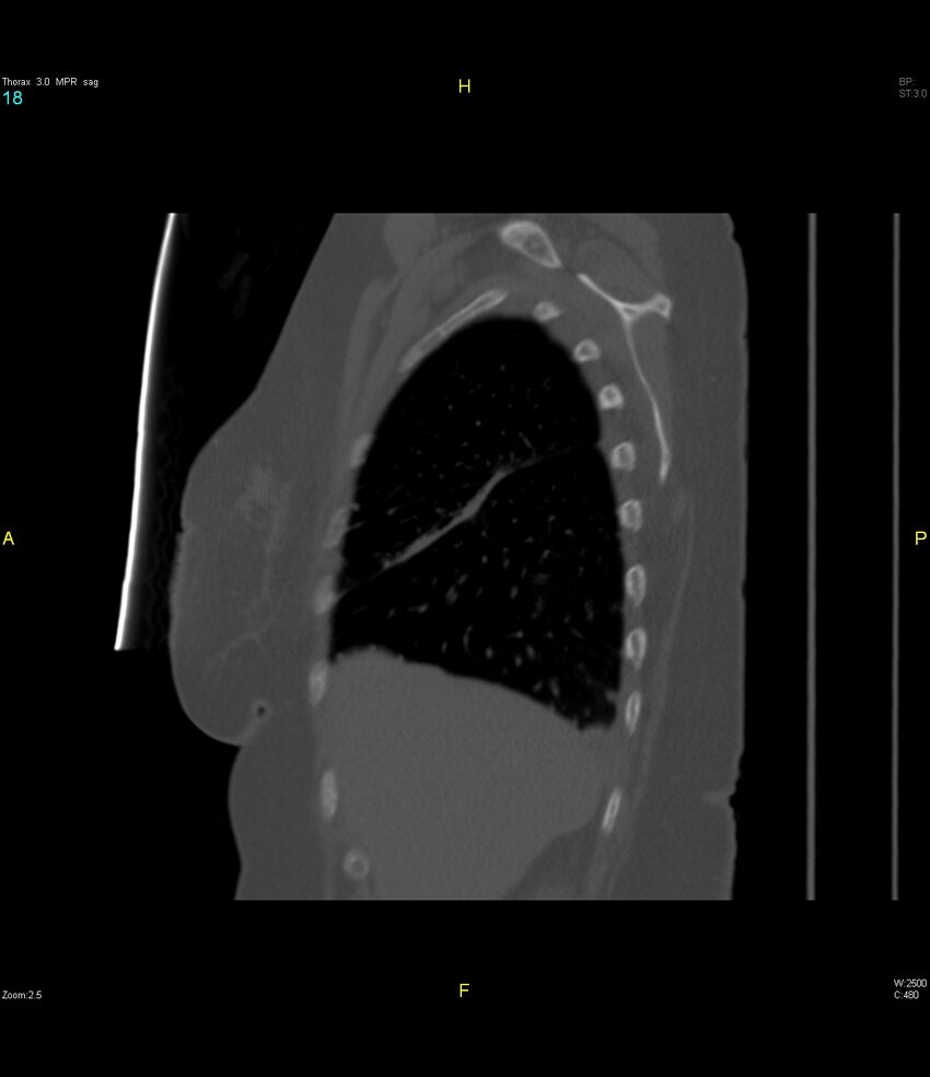 Breast primary with lung and bone metastases (Radiopaedia 40620-43228 Sagittal bone window 18).jpg