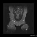 Broad ligament fibroid (Radiopaedia 49135-54241 Coronal STIR 3).jpg