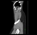 Broad ligament hernia (Radiopaedia 63260-71832 C 50).jpg