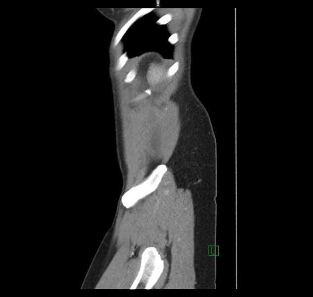File:Broad ligament hernia (Radiopaedia 63260-71832 C 50).jpg