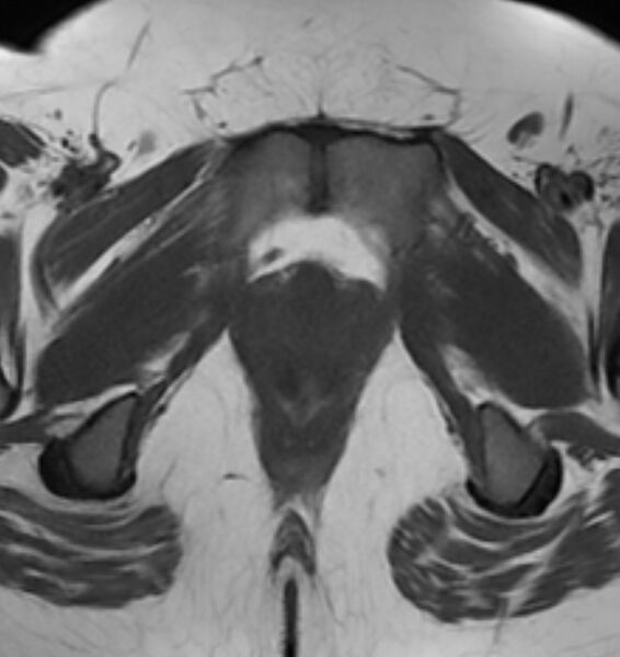 File:Broad ligament leiomyoma (Radiopaedia 81634-95516 Axial T1 25).jpg