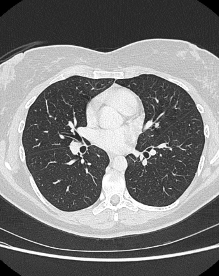 Bronchial atresia (Radiopaedia 50007-55297 Axial lung window 55).jpg