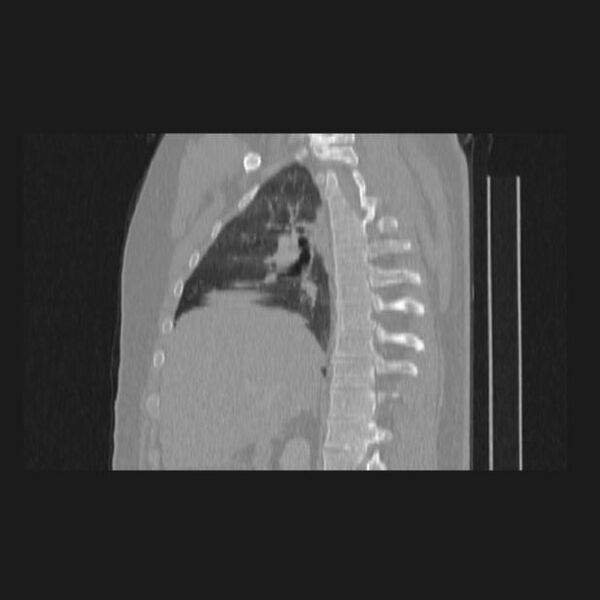 File:Bronchial atresia (Radiopaedia 60685-68439 Sagittal lung window 34).jpg