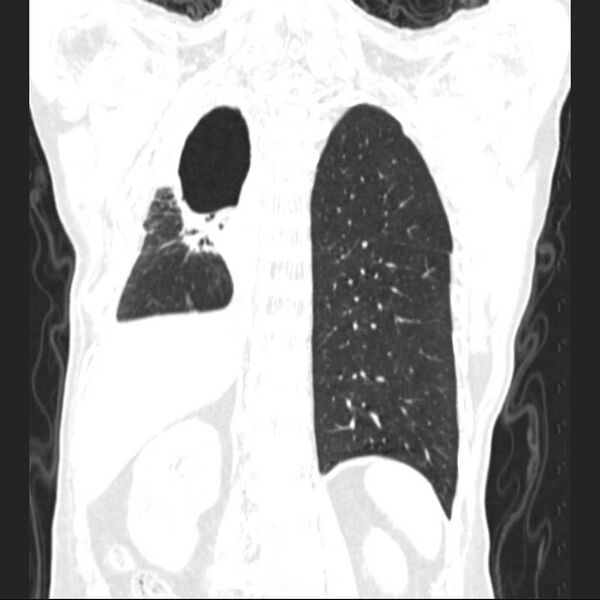 File:Bronchopleural fistula - postoperative complication (Radiopaedia 21020-20947 Coronal lung window 21).jpg