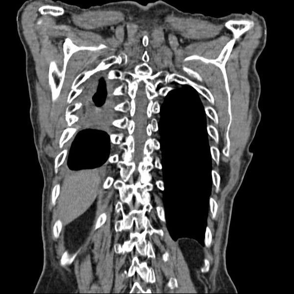 File:Bronchopleural fistula - postoperative complication (Radiopaedia 21020-20947 Coronal non-contrast 25).jpg