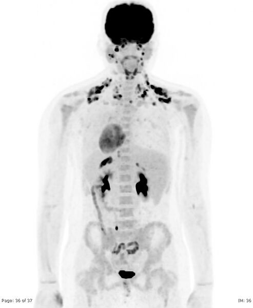 File:Brown fat uptake (FDG PET-CT) (Radiopaedia 77392-89513 MIP 35).jpg
