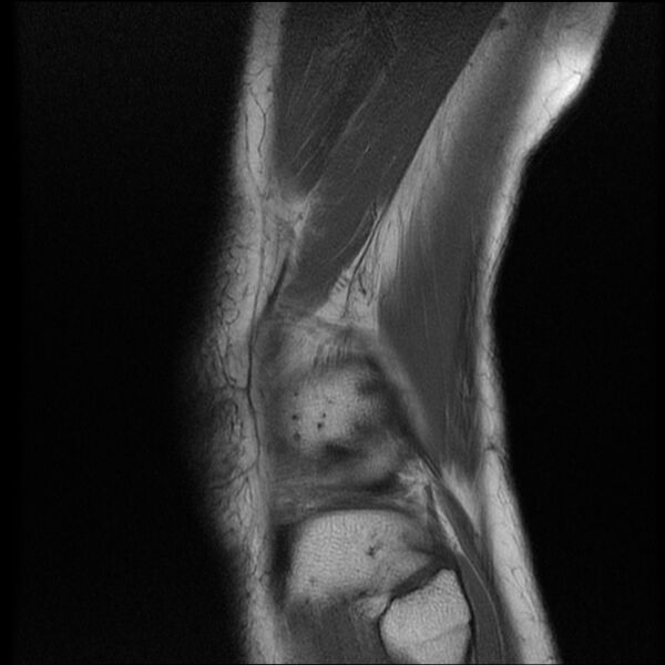 File:Bucket-handle meniscus tear (Radiopaedia 65700-74809 Sagittal T1 20).jpg