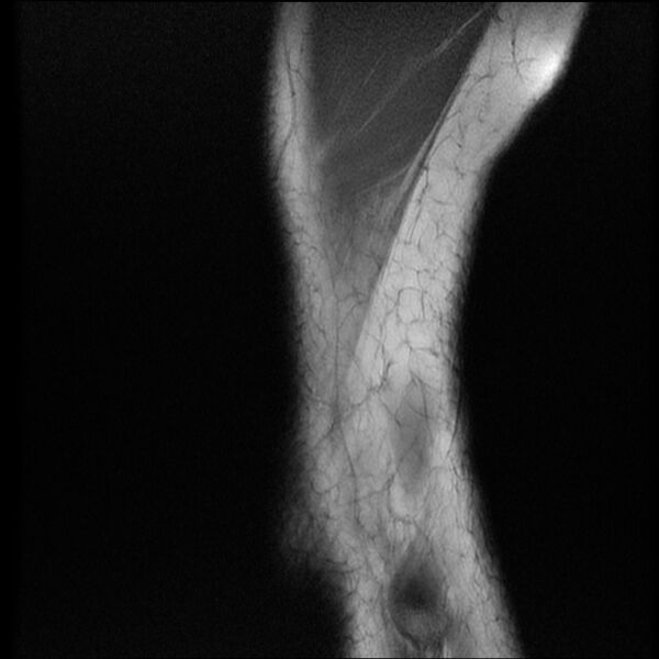 File:Bucket-handle meniscus tear (Radiopaedia 65700-74809 Sagittal T1 22).jpg