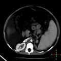 Budd-Chiari syndrome (Radiopaedia 23072-23103 C+ arterial phase 12).jpg