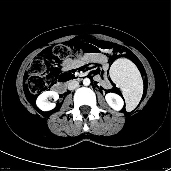 File:Budd-Chiari syndrome (Radiopaedia 27929-28177 Axial liver window 34).JPG