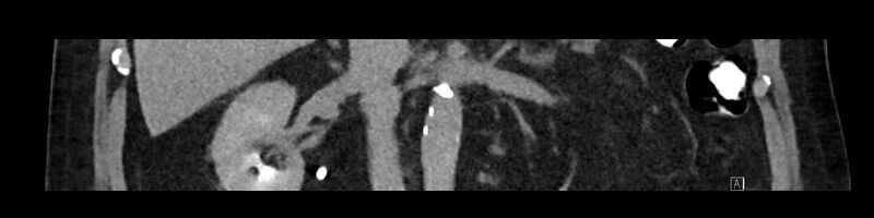 File:Buried bumper syndrome - gastrostomy tube (Radiopaedia 63843-72575 Coronal 14).jpg