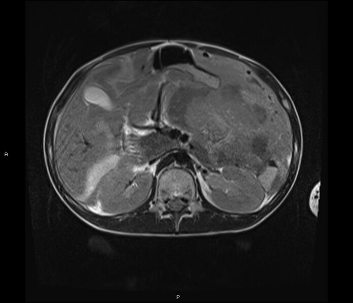 File:Burkitt lymphoma (bowel) (Radiopaedia 68839-78557 Axial T2 22).jpg