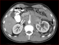 Burned-out testicular choriocarcinoma (Radiopaedia 32822-34040 B 6).PNG