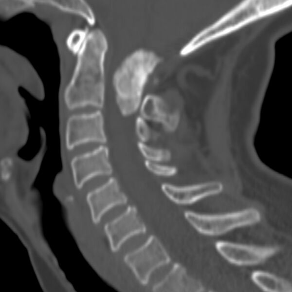 File:Calcified meningioma - cervical canal (Radiopaedia 70136-80171 Sagittal bone window 15).jpg