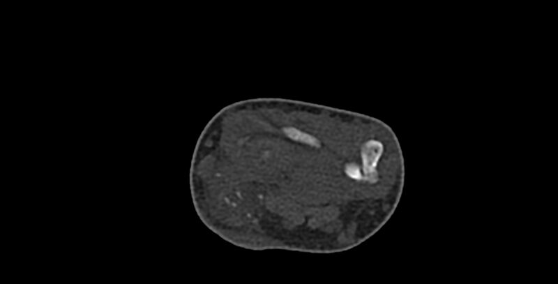 File:Calcifying aponeurotic fibroma (Radiopaedia 88423-105064 Axial bone window 41).jpg