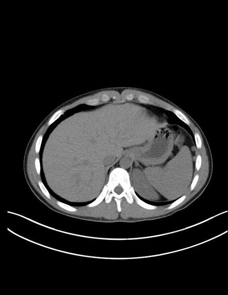 File:Calcifying pulmonary metastases (Radiopaedia 33359-34396 Axial non-contrast 27).jpg