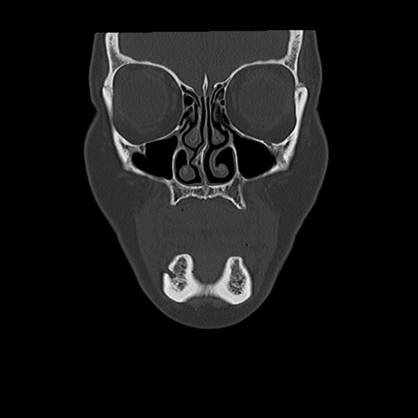 File:Canal up mastoidectomy (Radiopaedia 78108-90638 Coronal bone window 2).jpg