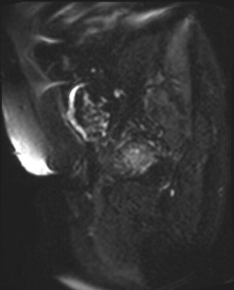 File:Cancer cervix - stage IIb (Radiopaedia 75411-86615 Sagittal DWI 20).jpg
