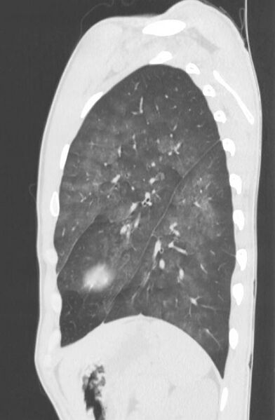 File:Cannabis-induced diffuse alveolar hemorrhage (Radiopaedia 89834-106946 Sagittal lung window 109).jpg
