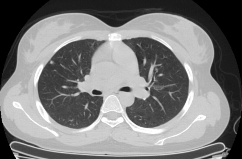 File:Cannonball metastases - uterine choriocarcinoma (Radiopaedia 70137-80173 Axial lung window 36).jpg