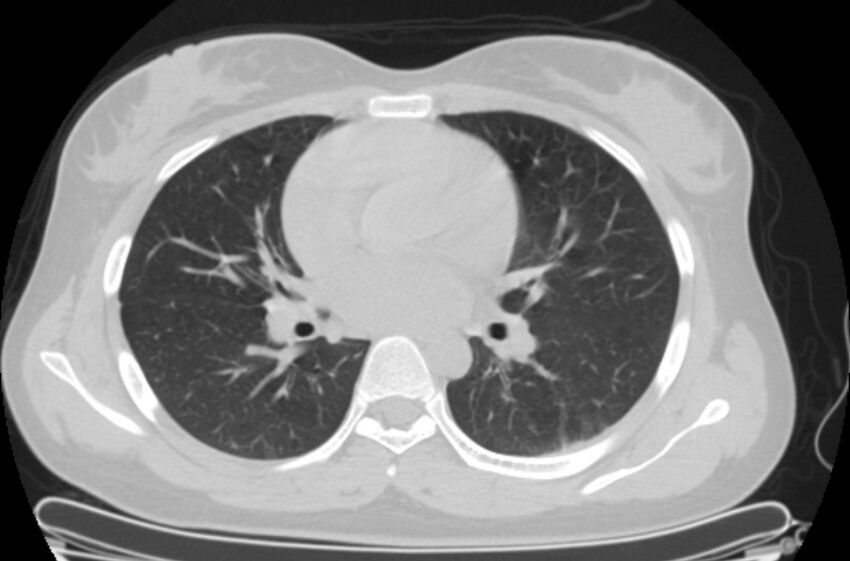 Cannonball metastases - uterine choriocarcinoma (Radiopaedia 70137-80173 Axial lung window 50).jpg