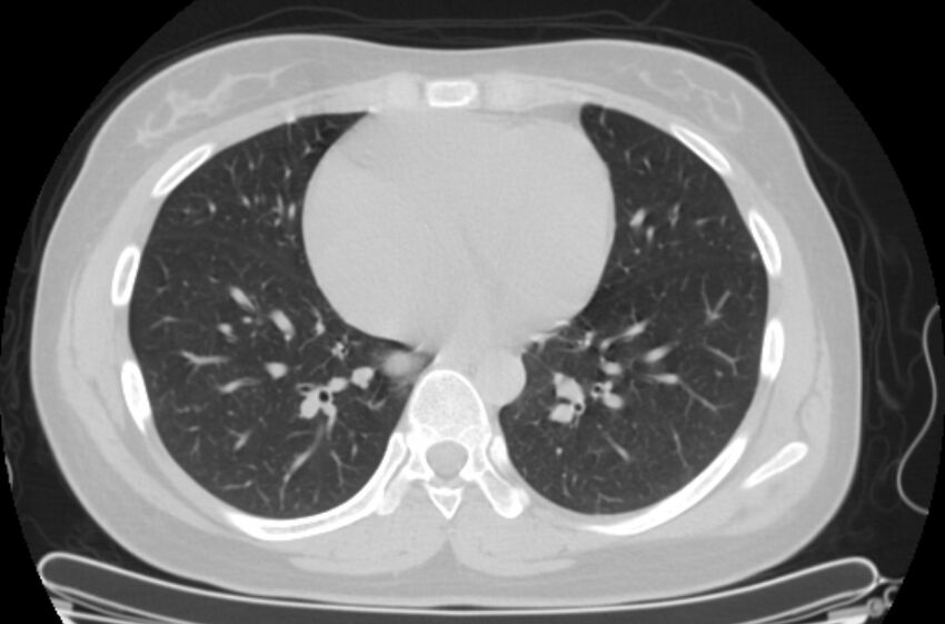 Cannonball metastases - uterine choriocarcinoma (Radiopaedia 70137-80173 Axial lung window 69).jpg