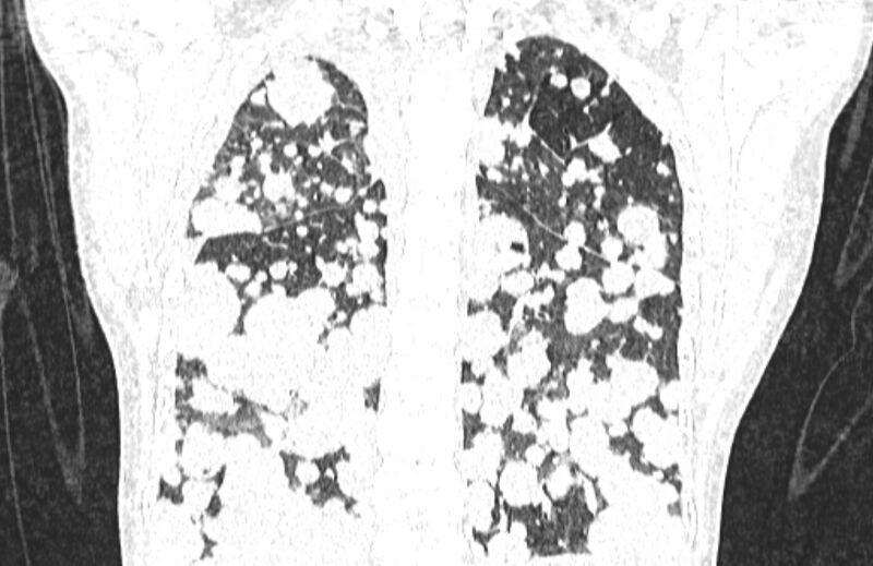 File:Cannonball metastases from breast cancer (Radiopaedia 91024-108569 Coronal lung window 108).jpg