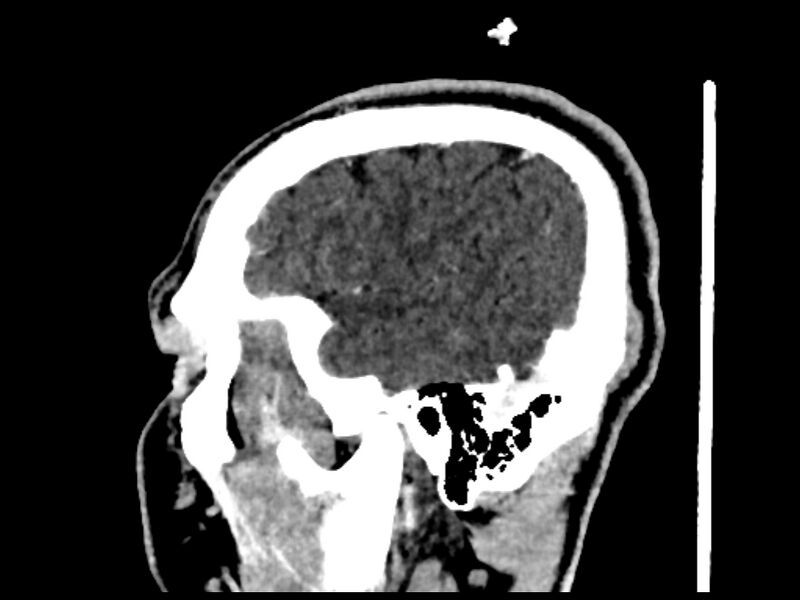 File:Capillary hemangioma of the orbit (Radiopaedia 44610-48358 C 9).jpg