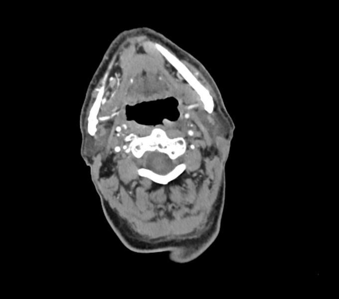 File:Carotid artery pseudoaneurysm (Radiopaedia 84030-99259 C 29).jpg