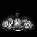 Carotid body tumor (Radiopaedia 21021-20948 A 21).jpg
